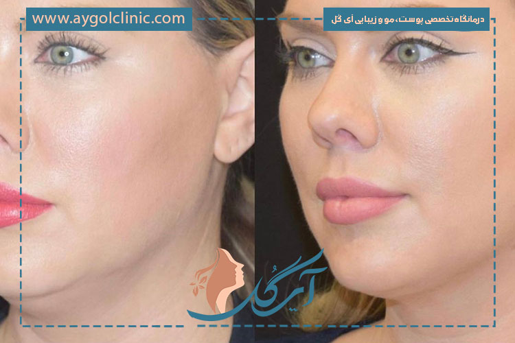 کاهش چربی ناحیه غبغب با لیپو غبغب باعث بهبود فرم فک و افزایش اعتماد‌به‌نفس می‌شود.