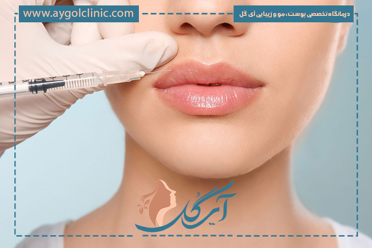 افزایش حجم طبیعی، فرم‌دهی زیبا و ماندگاری بالا از مزایای تزریق فیلر لب است.