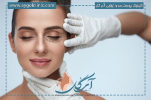 بلفاروپلاستی پلک پایین | رفع پف و چربی زیر چشم بدون رد بخیه ✨