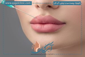 تزریق ژل لب مدل گرد؛ ۵ نکته بسیار مهم
