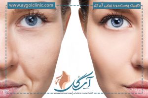 مزوژل چیست؟