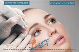 هزینه بلفاروپلاستی بدون جراحی ۱۴۰۵ 🏷️ | تعرفه پلک بالا و پایین