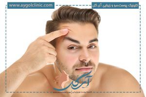 جراحی پلک افتاده چیست؟ | نحوه انجام، عوارض و مراقبتها