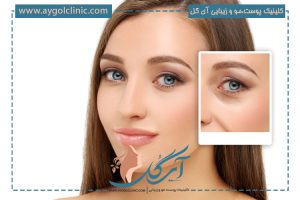 عمل پشت پلک چیست؟ مزایا و مراحل انجام آن + میزان ماندگاری نتایج