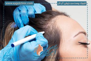 کاشت مو برای زنان در تهران | رویش طبیعی بدون نیاز به تراشیدن 👩‍🦰