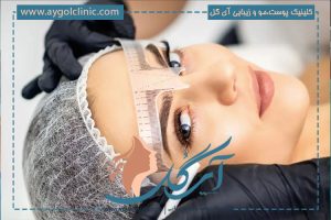 کاشت ابرو به روش FUT برای چه افرادی مناسب است؟ + ماندگاری آن