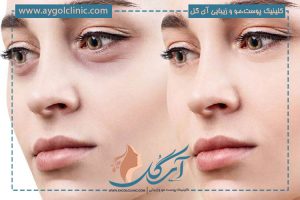 برداشتن پف زیر چشم با روش‌های جراحی و غیرجراحی؛ کدام مناسب است؟