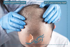 بهترین روش کاشت مو با تراکم بالا: راهنمای جامع برای نتایج طبیعی