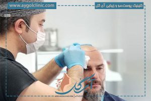 کاشت مو با بانک موی ضعیف: روش‌ها و نکات مهم
