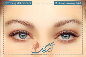 بلفاروپلاستی؛ نتیجه بخش ترین عمل افتادگی پلک چشم