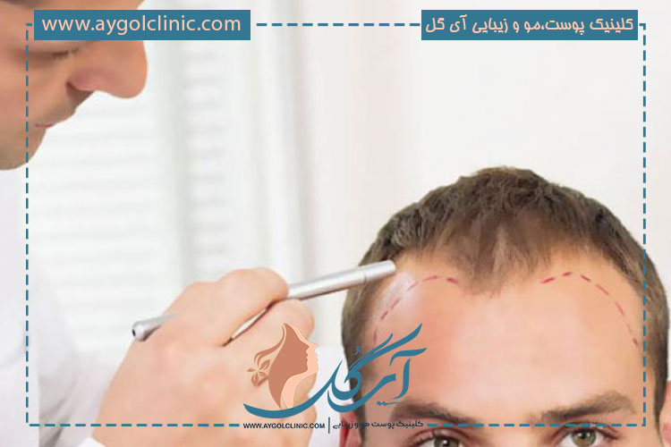 انجام ارزیابی‌ها و بررسی های تخصصی در فرایند کاشت مو به روش تکثیر