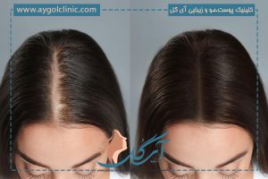 کاشت مو به روش تکثیر؛ نحوه انجام آن