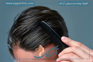 کاشت مو به روش میکروگرافت مزایا و معایب + هزینه | نحوه انجام آن ⚡