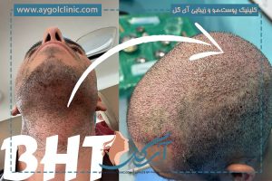 کاشت مو به روش BHT چیست؟ + مزایا و مراحل انجام | میزان موفقیت