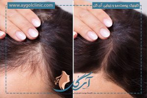 کاشت مو به روش FIT چیست؟ مزایا و فرآیند آن