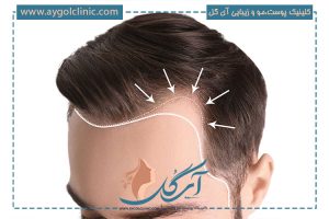  کاشت مو به روش FUE: مزایا و مراحل آن
