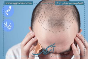 کاشت مو به روش Super FUE (سوپر اف یو ای)؛ مراحل، مزایا و نتایج