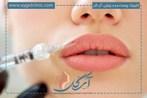 تزریق ژل لب مدل روسی (مشخصات و کاندیدای مناسب فرم لب)