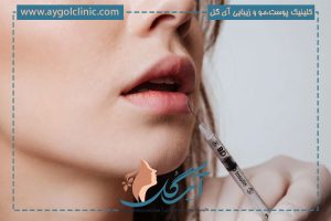 همه چیز در مورد تزریق ژل لب مدل سه دکمه ای + قیمت