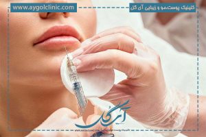 تزریق ژل لب مدل نچرال + عوارض و میزان ماندگاری آن