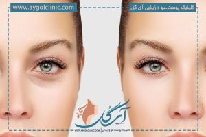 بلفاروپلاستی چگونه انجام میشود؟ + نحوه انجام بلفارو پلک بالا و پایین