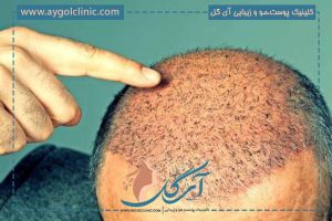 3 روش کاشت مو بدون درد و خونریزی