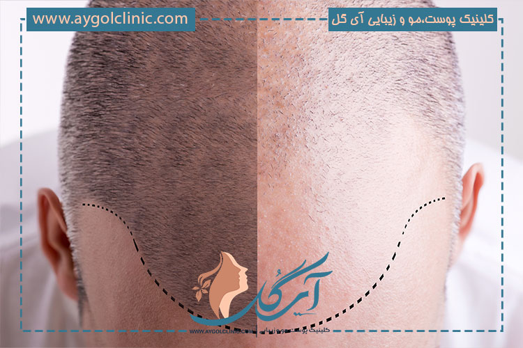 کاشت مو به روش ترکیبی: مراحل و مراقبت های قبل و بعد