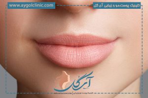 همه چیز درباره تزریق ژل لب مدل عروسکی: مزایا، مراقبت‌ها و هزینه‌ها