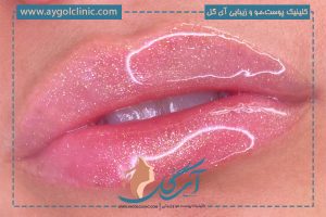تزریق ژل لب مدل باربی (ماندگاری و تفاوت فرم عروسکی با باربی)
