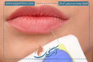 تزریق ژل لب مدل قلبی + نکات مراقبتی و قیمت