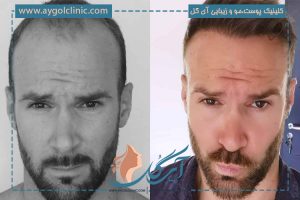 جدیدترین روش کاشت مو در آمریکا (5 روش برای رفع طاسی)