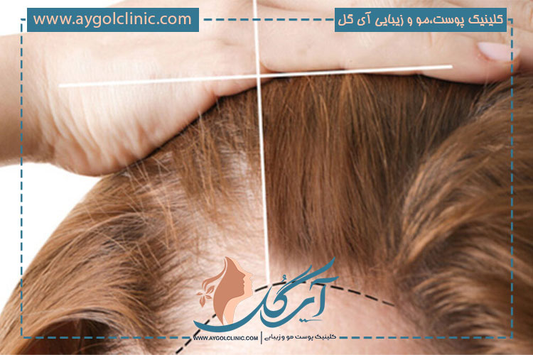 آیا جدیدترین روش کاشت مو در آمریکا در ایران هم اجرا می شود؟