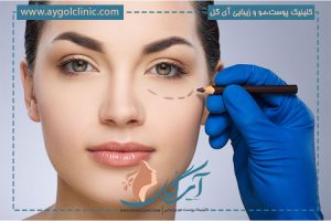 تزریق فیلر زیر چشم؛ پاسخ به مهم ترین سوالات زیباجویان