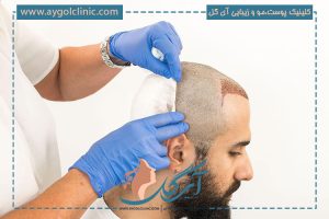 مراقبت‌های بعد از کاشت مو ( راهنمای قدم به قدم )