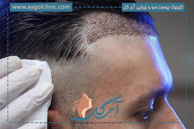 نظر تخصصی کلینیک در مورد روش کاشت مو بدون تراشیدن موی سر