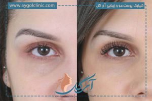 عوارض فیلر زیر چشم: نکات مهم برای ایمنی و کاهش عوارض