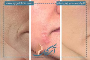 مراقبت های بعد از فیلر خط خنده + نحوه شستشو و بهترین غذاها