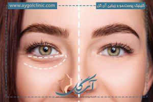 بهترین نوع فیلر زیر چشم‎ چیست؟ معرفی برندها
