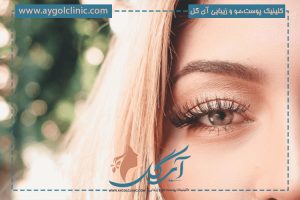 جای بخیه بعد از بلفاروپلاستی؛ روش کشیدن بخیه و درمان آن