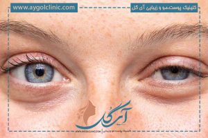 پتوز چشم چیست؟ علت آن، معرفی بهترین درمان