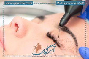 پلاسما جت پلک چیست و چه عملکرد و تاثیری دارد؟