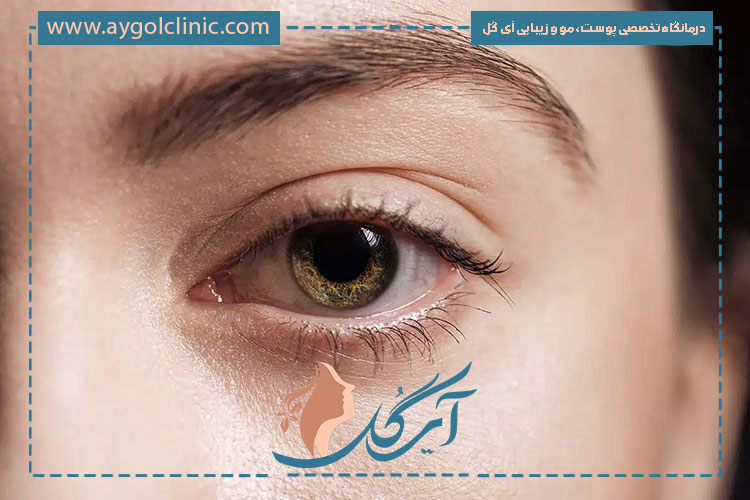 نقش تغذیه نامناسب در افتادگی پلک