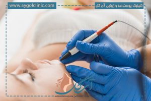 راهنمای کامل الکترولیز موهای زائد؛ جزئیات کاربردی و مهم