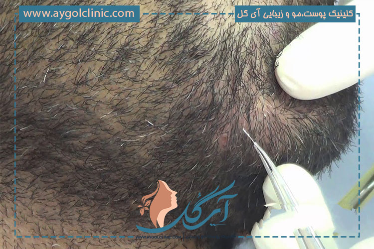 کلینیک آی گل یک مرکز تخصصی پوست و مو در تهران