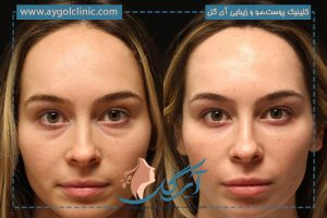 جراحی پلک چشم؛ تکنیک‌ها و روش کار، عوارض و هزینه‌ها