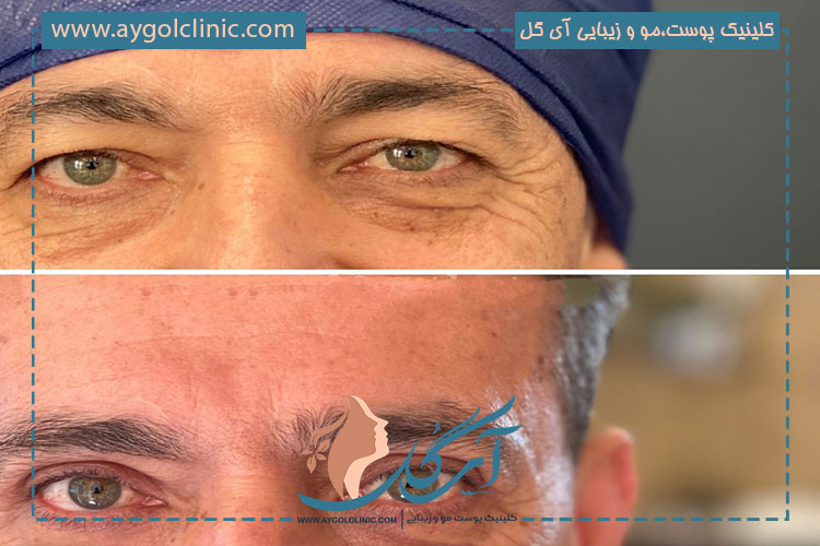 جراحی پلک بالایی چشم