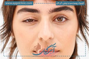 ۱۰ علت پنهان افتادگی پلک در جوانی که باید بشناسید!