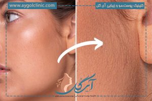 آیا لیزر موهای کرکی را از بین میبرد؟