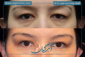 علت کوچک شدن چشم بعد از عمل بلفاروپلاستی چیست؟