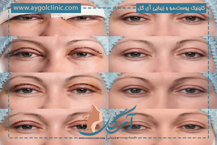 مهمترین اقدامات برای جلوگیری از کوچک شدن چشم بعد از عمل بلفاروپلاستی